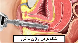 تنگ کردن واژن با لیزر