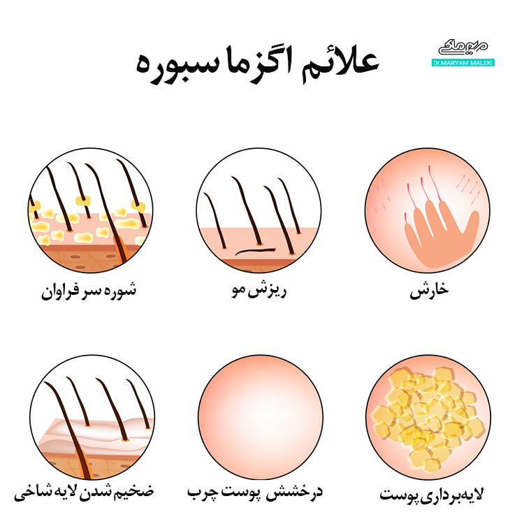 علائم درماتیت سبورئیک