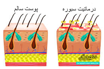 درماتیت سبوره