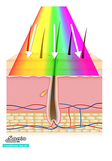 لیزر موهای زائد با آِی پی ال  IPL