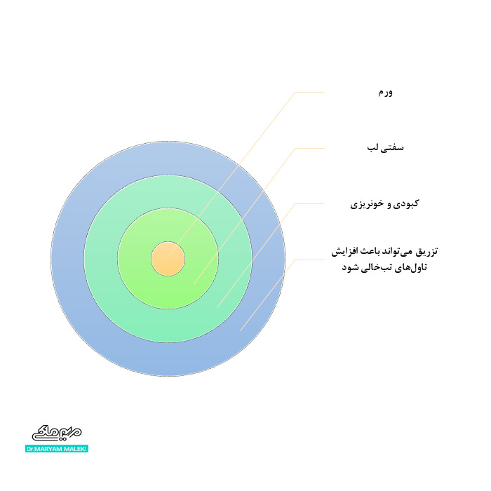 عوارض ژل در لب