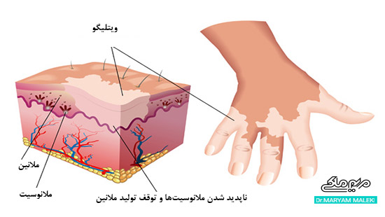 پیدایش ویتلیگو