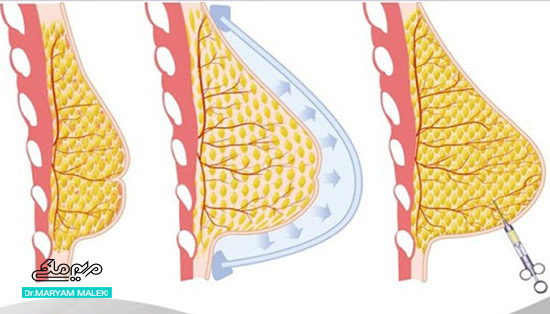 تزریق چربی به سینه