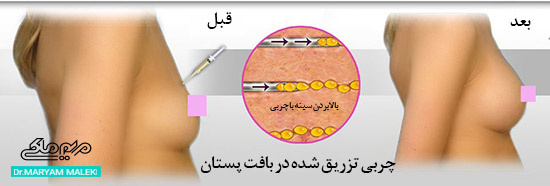 تزریق چربی به پستان