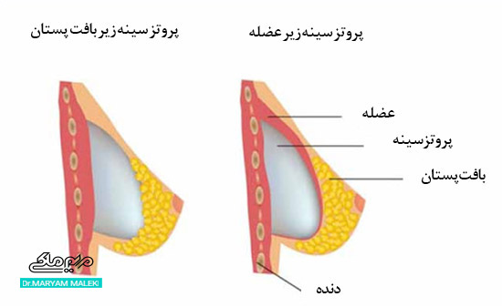 پروتز سینه‌ها