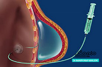 تزریق ژل به سینه‌ها