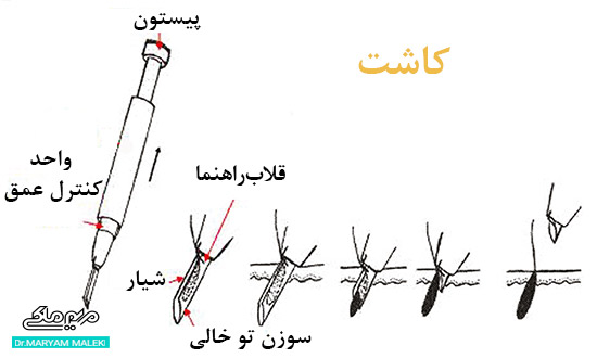  روش Stick and Place