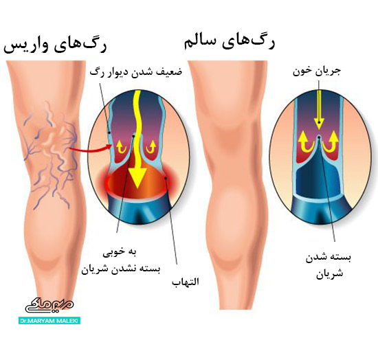 تفاوت رگ‌های نرمال با رگ‌های واریس