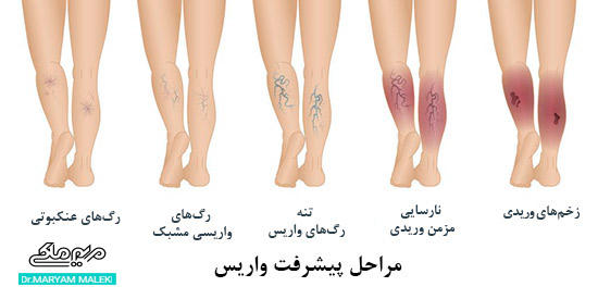 مراحل پیشرفت واریس