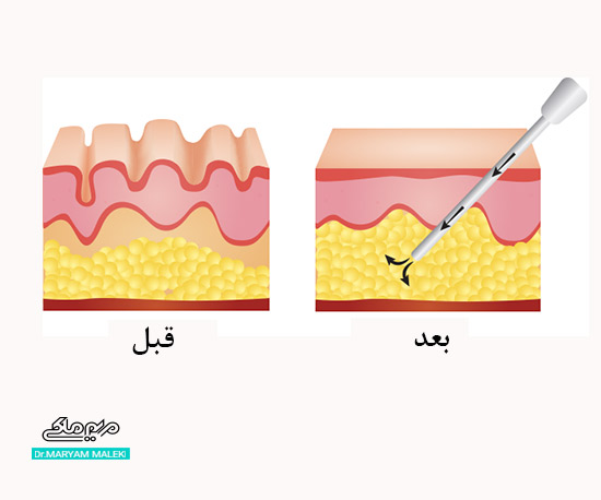 تزریق چربی زیر چشم