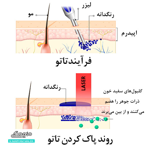 پاک کردن تاتو با لیزر