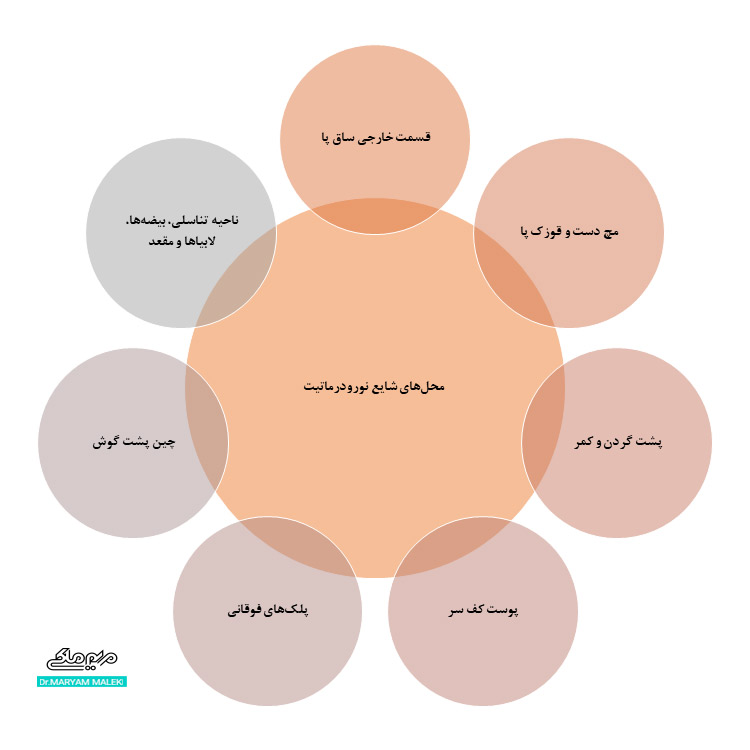 محل‌های شایع نورودرماتیت