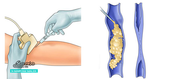 روند انجام اسکلروتراپی
