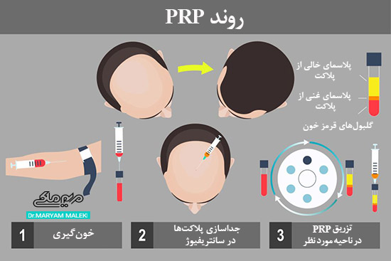 روند PRP