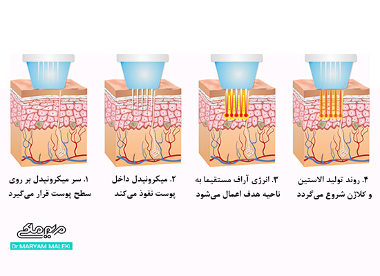 مراحل آراف فرکشنال