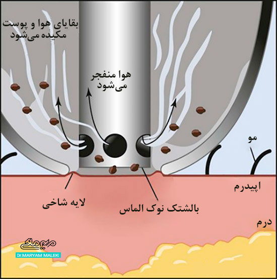 میکرودرم ابریژن سر الماسی