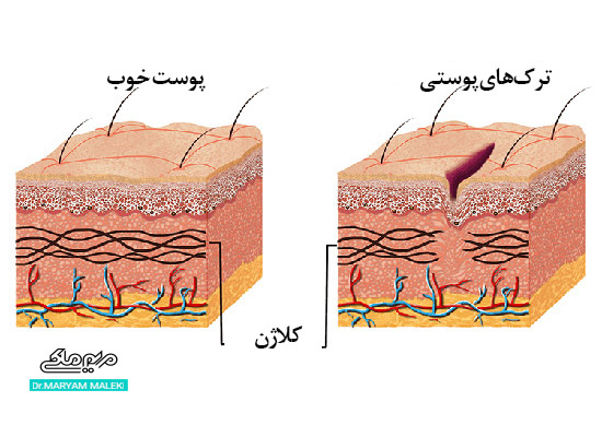 تفاوت پوست خوب با پوستی با ترک‌های پوستی