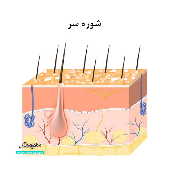 شوره سر و جوش صورت