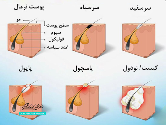 انواع آکنه 