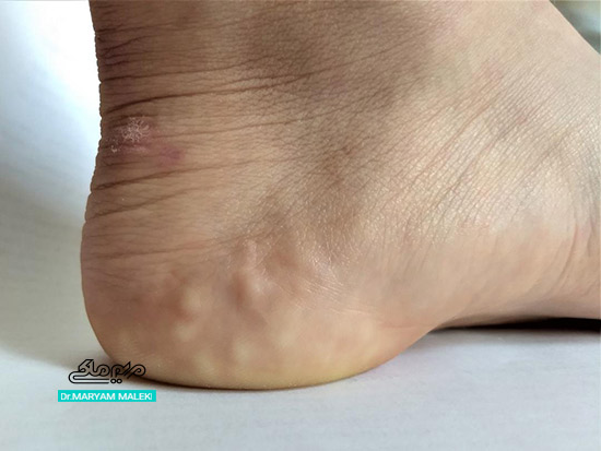 پاپولهای پیزوژنیک