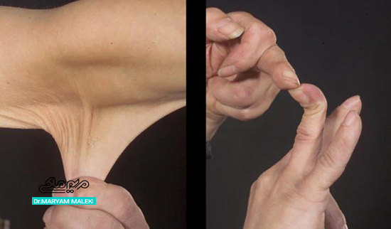 اهلرز-دنلوس (Ehlers–Danlos syndrome)