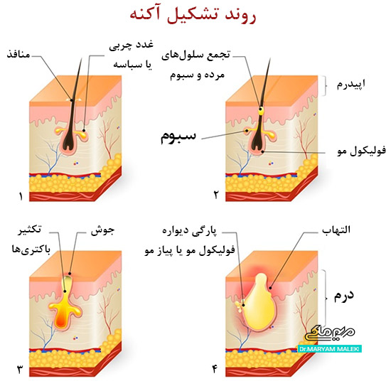 روند تشکیل آکنه