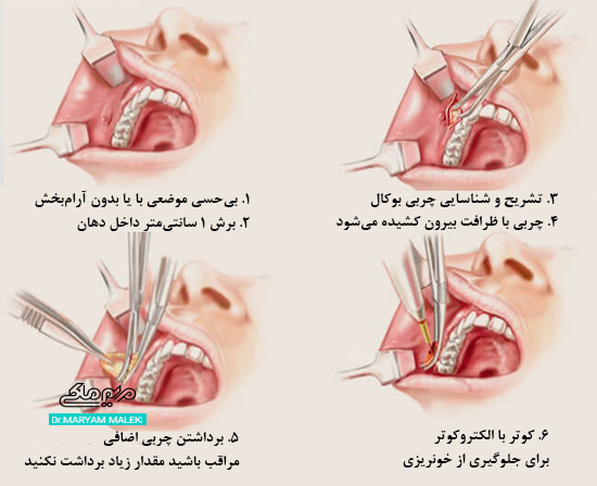 روش عمل جراحی بوکال فت