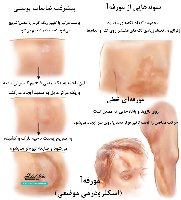 مشخصات مورفه آ