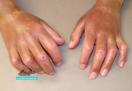 فرم منتشر Diffusc cutaneous systemic sclerosis