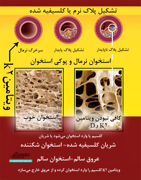 پوکی استخوان یا استخوان نرمال با ویتامین K2