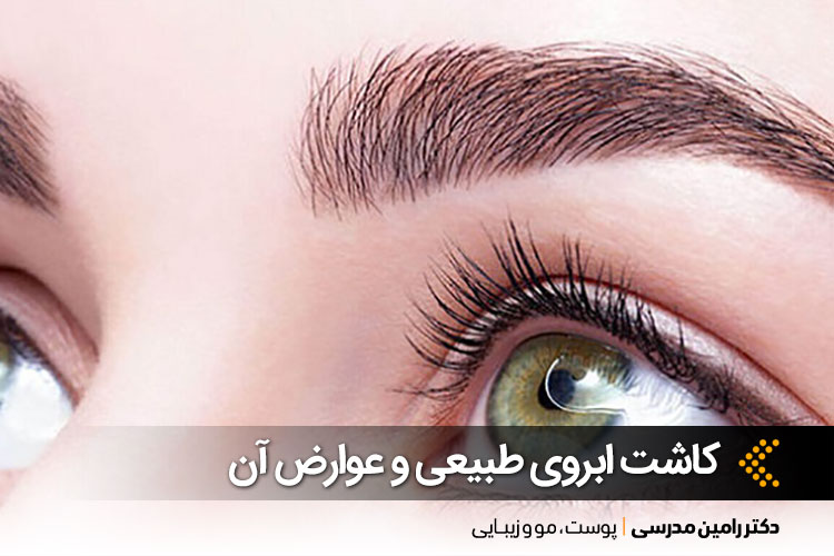 کاشت ابروی طبیعی در کلینیک دکتر رامین مدرسی 