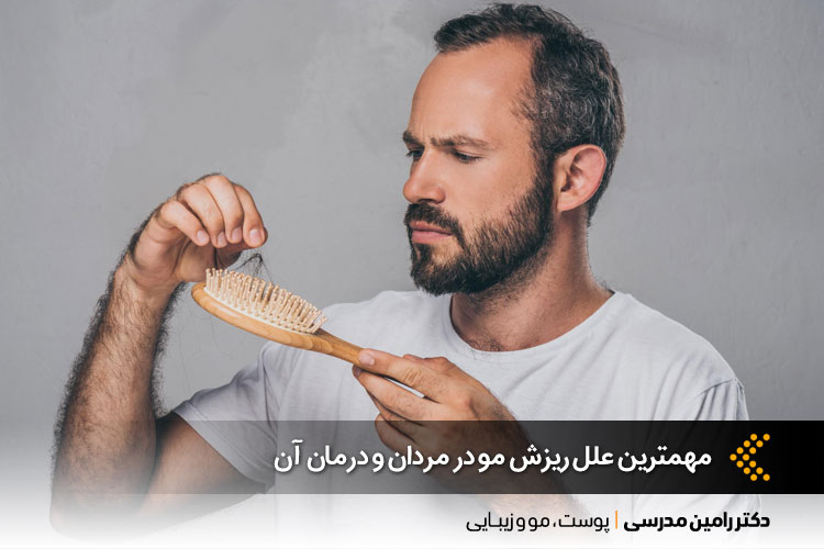 درمان ریزش مو مردان