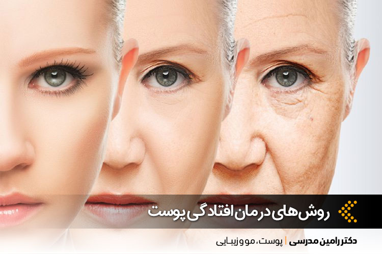 افتادگی پوست چگونه درمان میشود؟ | لیفت پوست در اصفهان | دکتر رامین مدرسی