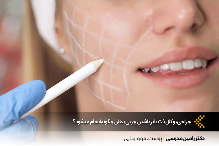 عمل جراحی بوکال فت چیست؟ | بهترین جراح بوکال فت در اصفهان