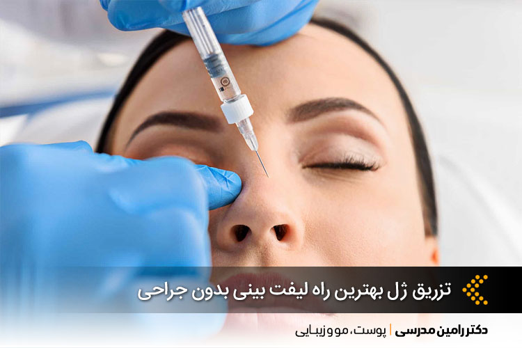 تزریق ژل، بهترین راه لیفت بینی بدون جراحی