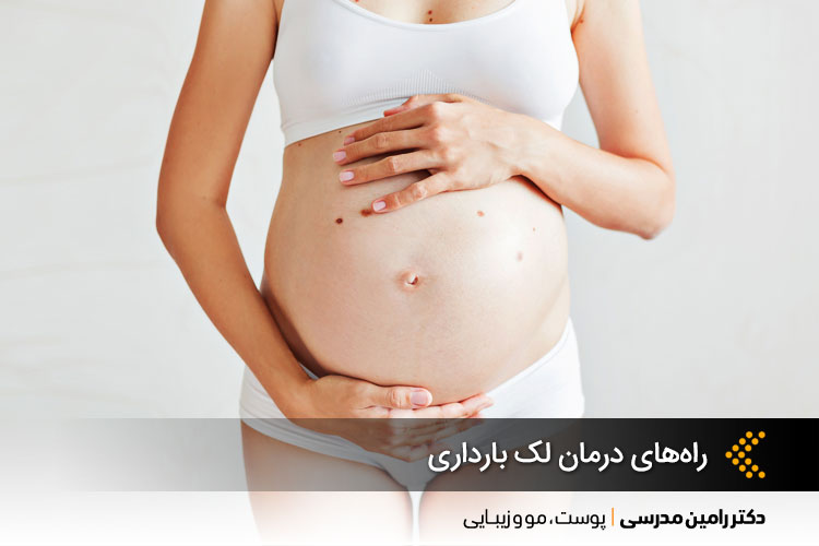 راه‌های درمان لک بارداری