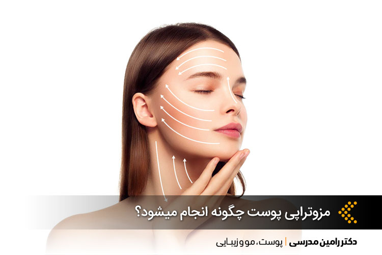 مزوتراپی پوست چگونه انجام میشود؟