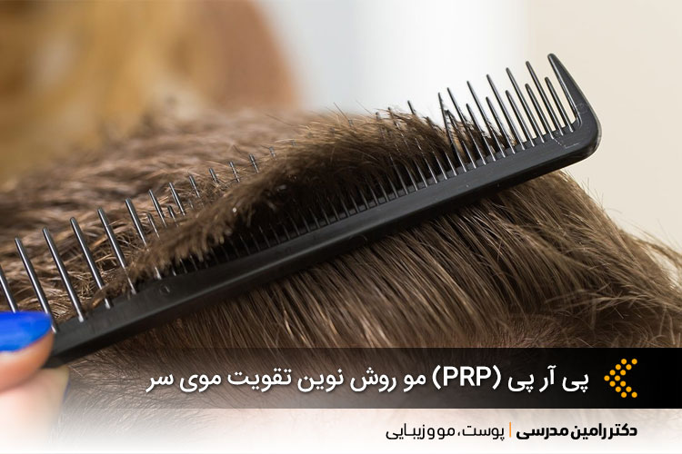 پی آر پی (PRP) مو