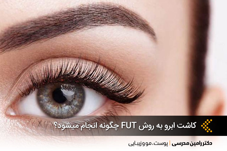 کاشت ابرو به روش FUT 