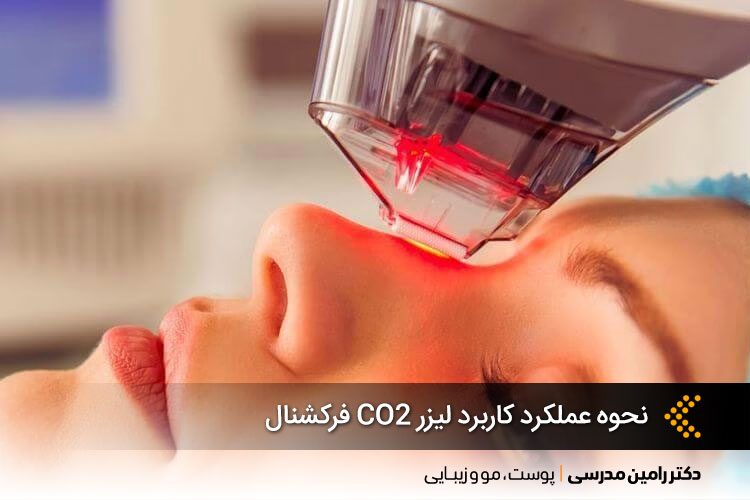  لیزر CO2 فرکشنال