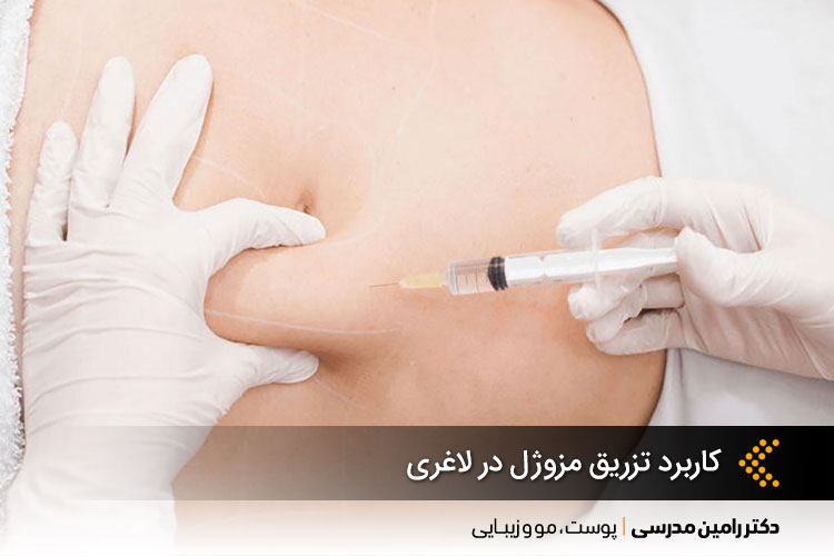 کاربرد تزریق مزوژل در لاغری	