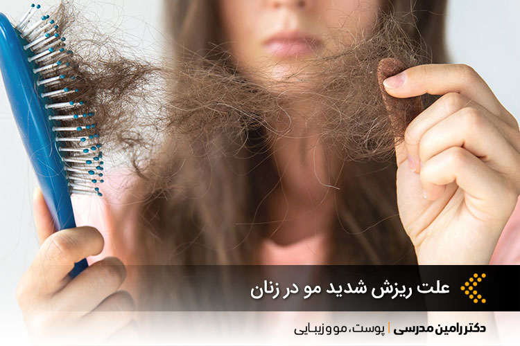 ریزش شدید مو در زنان