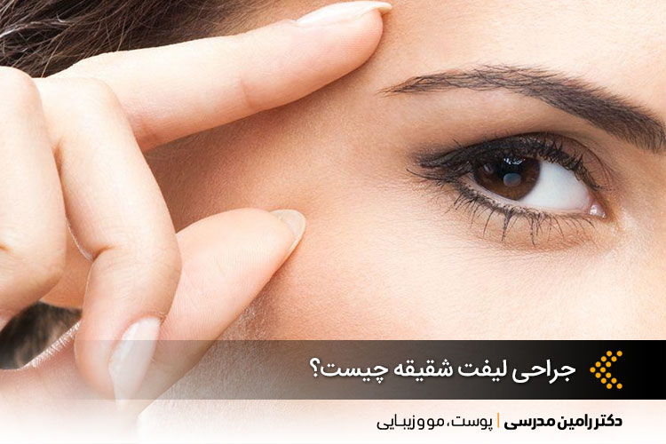 جراحی لیفت شقیقه