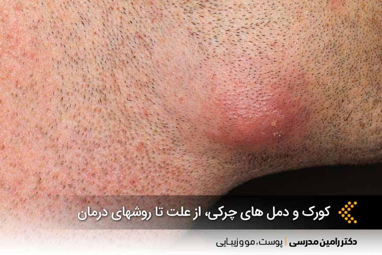 کورک و دمل های چرکی