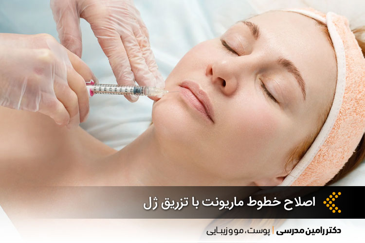 اصلاح خطوط ماریونت با تزریق ژل