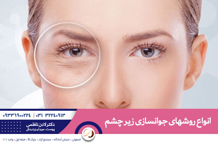 روش های جوانسازی زیر چشم