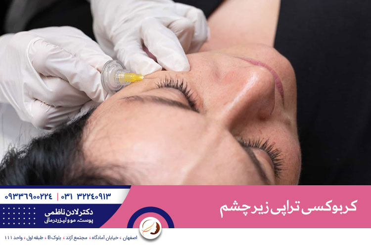 کربوکسی تراپی زیر چشم