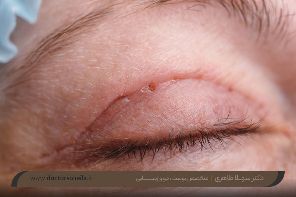 عوارض جراحی بلفاروپلاستی