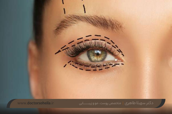 سن مناسب بلفاروپلاستی 