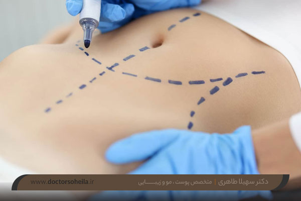 مراقبت های بعد از لیپوساکشن 